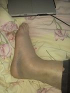 ankle2